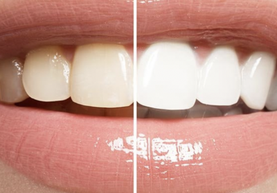 Teeth whitening