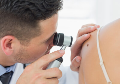 Checking the mole at a dermatologist to prevent skin cancer
