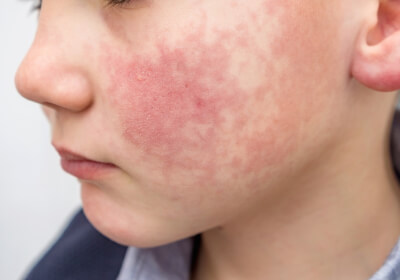 Red cheeks in children - could it be the fifth disease?