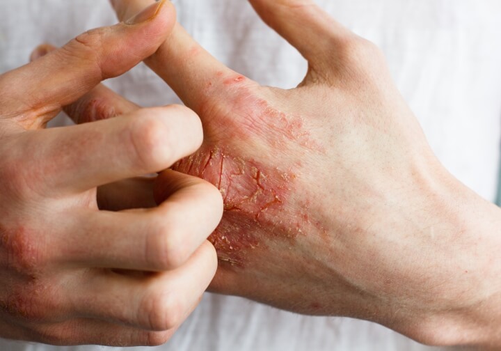 How to get rid of eczema: causes, treatment, and long-term skin care