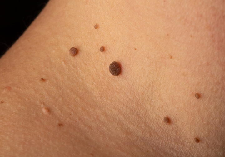 How to remove skin growths